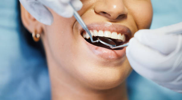 Best Emergency Wisdom Tooth Extraction in Esperance, WA