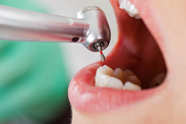 Best Knocked-Out Tooth (Avulsed Tooth) Treatment in Esperance, WA